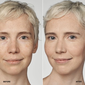 Before and after close-up showing Clinique Even Better Clinical Serum Foundation SPF20 results
