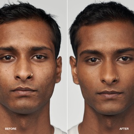Clinique Even Better Clinical Serum Foundation SPF20 before and after shot showing improved skin tone and reduced blemishes on male model