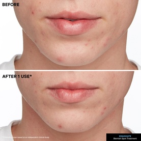 EradiKate Acne Treatment
