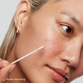 EradiKate Acne Treatment