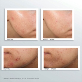 Outsmart Blemish Clarifying Treatment
