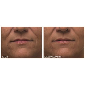 Alpha Beta&reg; Ultra Gentle Daily Peel