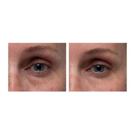 Hyaluronic Marine&trade; Dew It Right&trade; Eye Gel