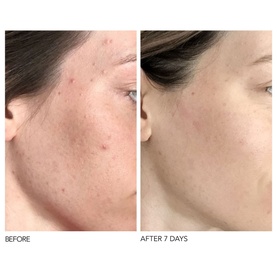 Alpha Beta&reg; Universal Daily Peel 30 Pack