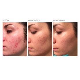 DRx Blemish Solutions&trade; Breakout Clearing Gel