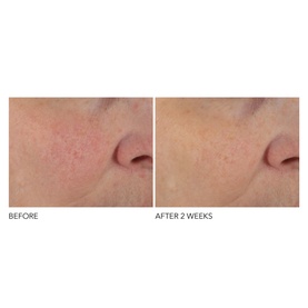 Advanced Retinol + Ferulic Overnight Texture Renewal Peel