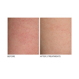 Alpha Beta&reg; Exfoliating Body Treatment 8 Pack