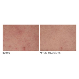 Alpha Beta&reg; Exfoliating Body Treatment 8 Pack