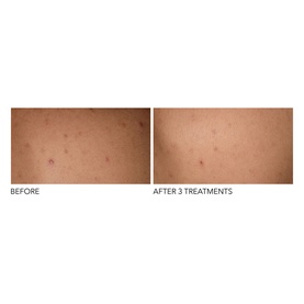 Alpha Beta&reg; Exfoliating Body Treatment 8 Pack