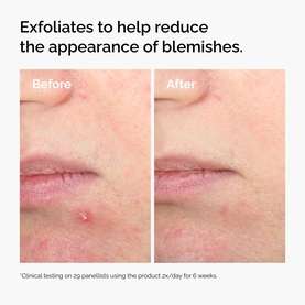 Salicylic Acid 2% Solution