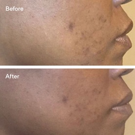 Before and after close-up showing reduced dark spots and discoloration on cheek skin after using Murad Correct & Protect Broad Spectrum SPF 45