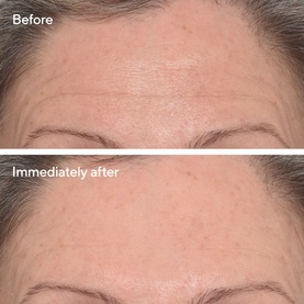 Targeted Wrinkle Corrector