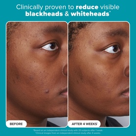 Skin Perfecting 2% BHA Liquid Exfoliant