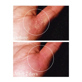Quick Relief Moisture Treatment