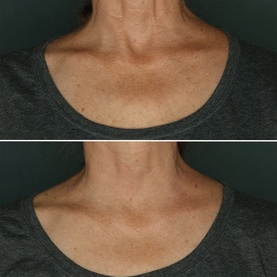 Before and after close-up of neck and d&eacute;colletage skin, showing improved firmness and texture after using Sol De Janeiro Beija Flor Elasti-Cream