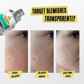 Truly Targeted Blemish-Clearing Solution