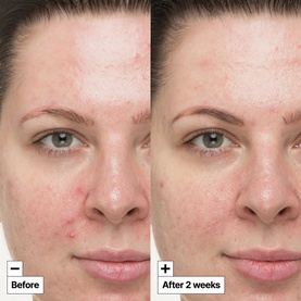  Cicapair&trade; So Soothing Treatment