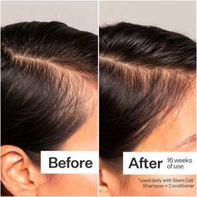 Stem Cell Peptide Scalp Treatment