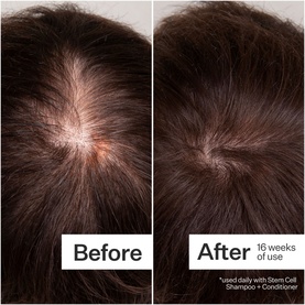 Stem Cell Peptide Scalp Treatment