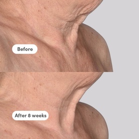The Elevator Neck + D&eacute;collet&eacute; Concentrate