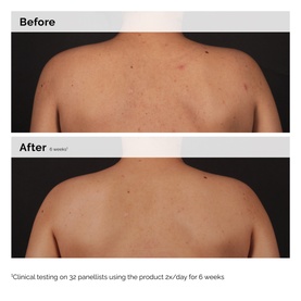 Salicylic Acid 0.5% Body Serum