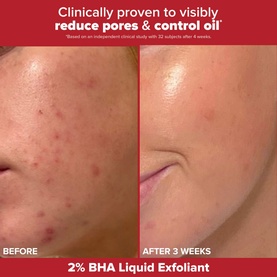 The Breakout Resolution Skincare Gift Set