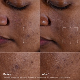 Before and after results of CLINIQUE Even Better Clinical Dark Spot Clearing Serum, showing reduced dark spots on skin after 12 weeks of use