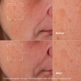 CLINIQUE Even Better Clinical Dark Spot Clearing Serum before and after results showing reduced dark spots after 12 weeks of use