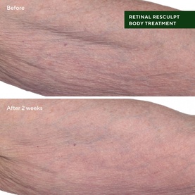 Retinal ReSculpt&trade; Body Treatment 
