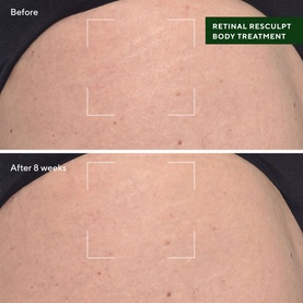Retinal ReSculpt&trade; Body Treatment 