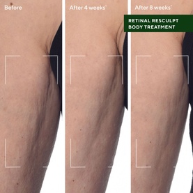 Retinal ReSculpt&trade; Body Treatment 
