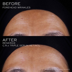  R&eacute;nergie CRx Triple Serum Retinol