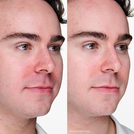 Anti-Blemish Solutions Clinical Advanced Clearing Gel