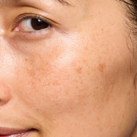 The Hyperpigmentation Serum