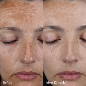 The Hyperpigmentation Serum Refill