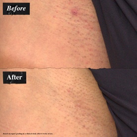 Ingrown Hair and Tone Correcting Intimate Drops