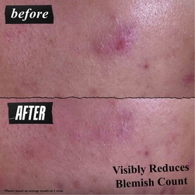Gently Effective Blemish Treating Cleansing Paste