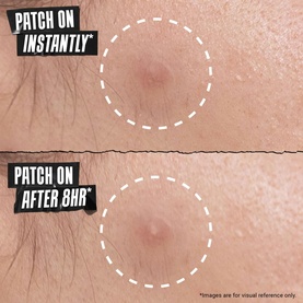 Acne Clearing Patch P22