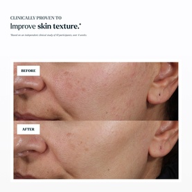 Skin Rocks The Strong Acid before and after comparison showing improved skin texture on cheek area over 4 weeks