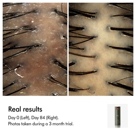 Before and after scalp close-up showing reduced flaking after 84 days of use during a 3-month trial