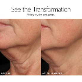 Before and after close-up of neck and jawline showing visible lifting and firming results after 12 weeks use of Estee Lauder serum.