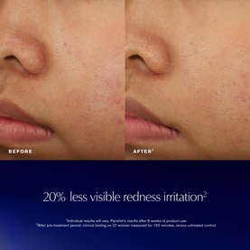 Estee Lauder Advanced Night Repair Recovery Treatment Lotion before and after showing 20% less visible redness irritation on skin
