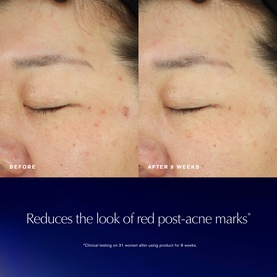 Estee Lauder Advanced Night Repair Recovery Treatment Lotion before and after 8 weeks, showing reduced red post-acne marks on skin
