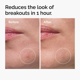 The Ordinary The Target & Treat Set before and after comparison showing reduced appearance of breakouts on skin within 1 hour