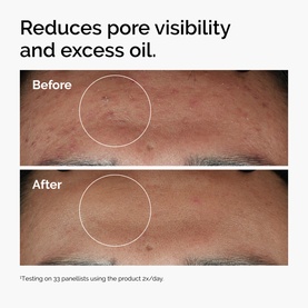 The Ordinary The Target & Treat Set before-and-after showing reduced pore visibility and excess oil on forehead skin