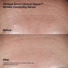 Clinique Smart Clinical Repair&trade; Wrinkle Correcting Cream Gift Set before and after results showing visible reduction in forehead wrinkles after 16