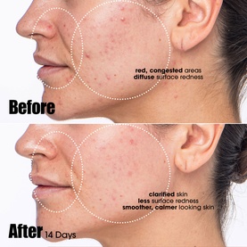 Sunday Riley serum before and after results over 14 days, showing reduced redness and clearer, calmer-looking skin