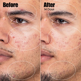 Before and after comparison showing Sunday Riley serum results on male skin after 14 days, with reduced blemishes and improved clarity.
