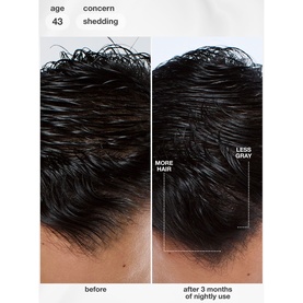 K18 FutureIQ Biomimetic Hair Longevity Serum before and after: more hair, less grey after 3 months of nightly use, age 43, shedding concern