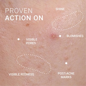 Sisley Corrective Serum Blemish Prone Skin close-up skin texture showing targeted action on shine, blemishes, pores, redness and post-acne marks
